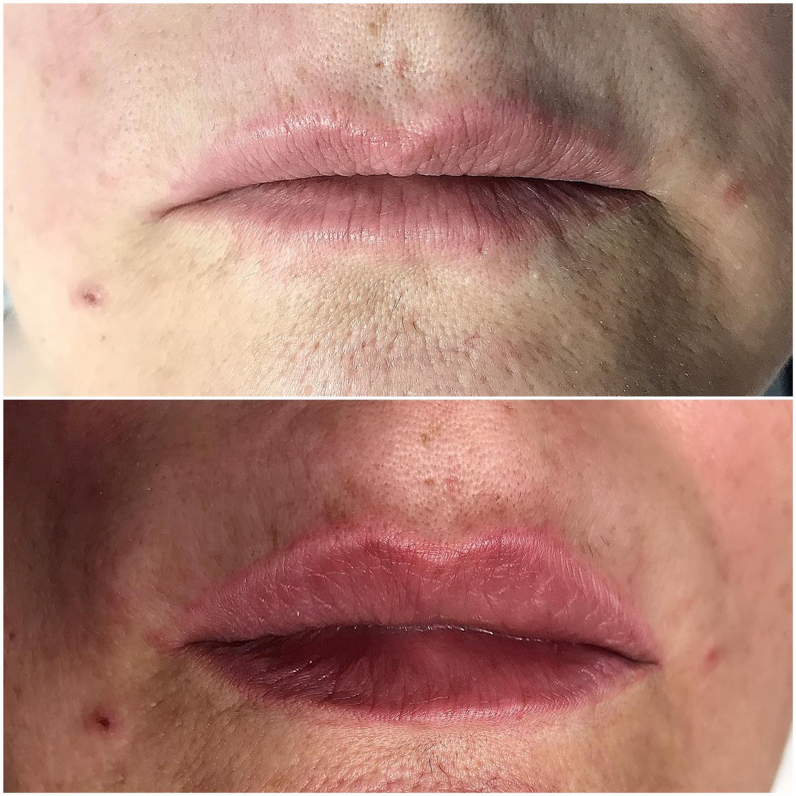 Hyaluronic Lip Filler Training / Lip filler training course Why train