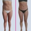 Cryo Vacuum Fit VF100 Weight loss Pro Kit - Image 9