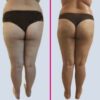 Cryo Vacuum Fit VF100 Weight loss Pro Kit - Image 4